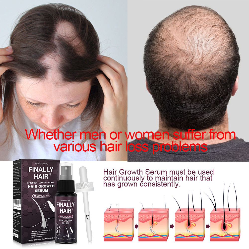 hair loss remedy monixidil hair regrowth treatment biotion callogen solution for hair loss